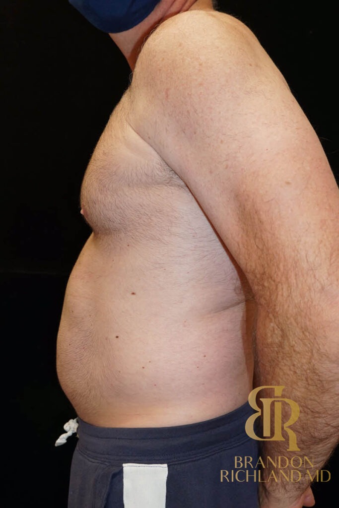Liposuction Before, Patient 03, view 5 — Dr. Brandon Richland, Newport Beach