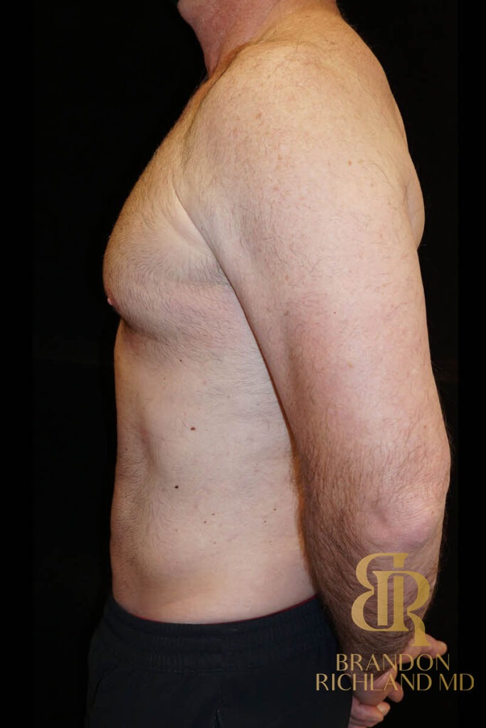 Liposuction After, Patient 03, view 5 — Dr. Brandon Richland, Newport Beach