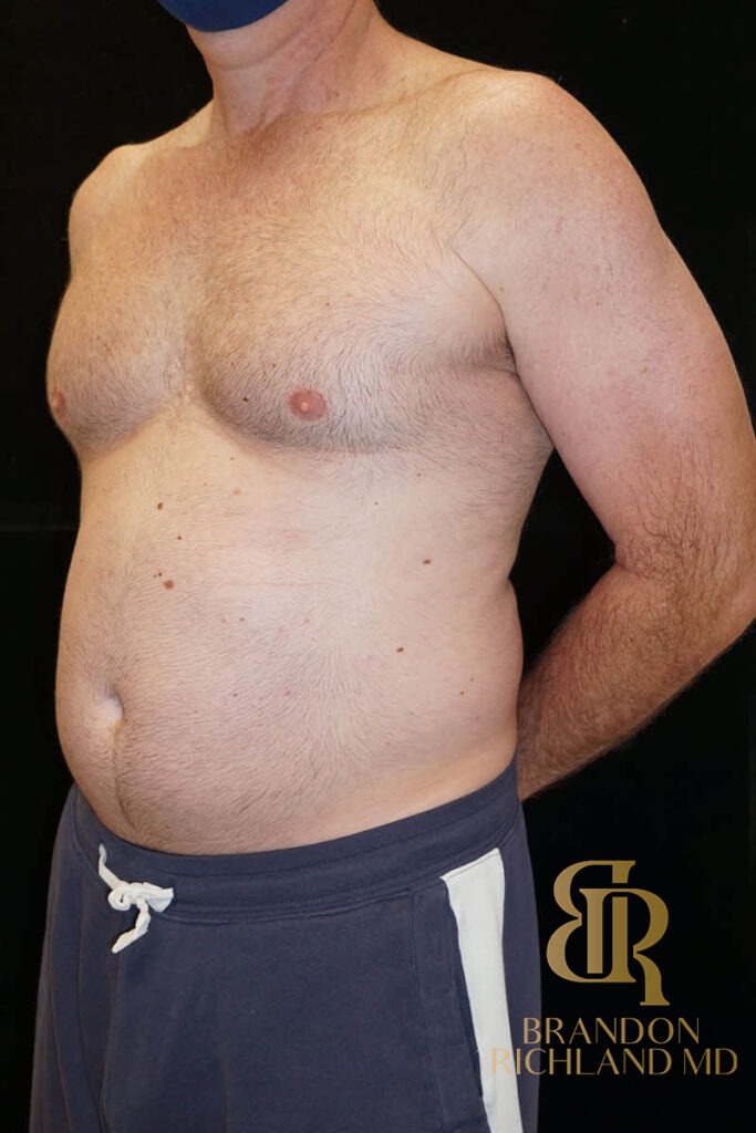 Liposuction Before, Patient 03, view 6 — Dr. Brandon Richland, Newport Beach