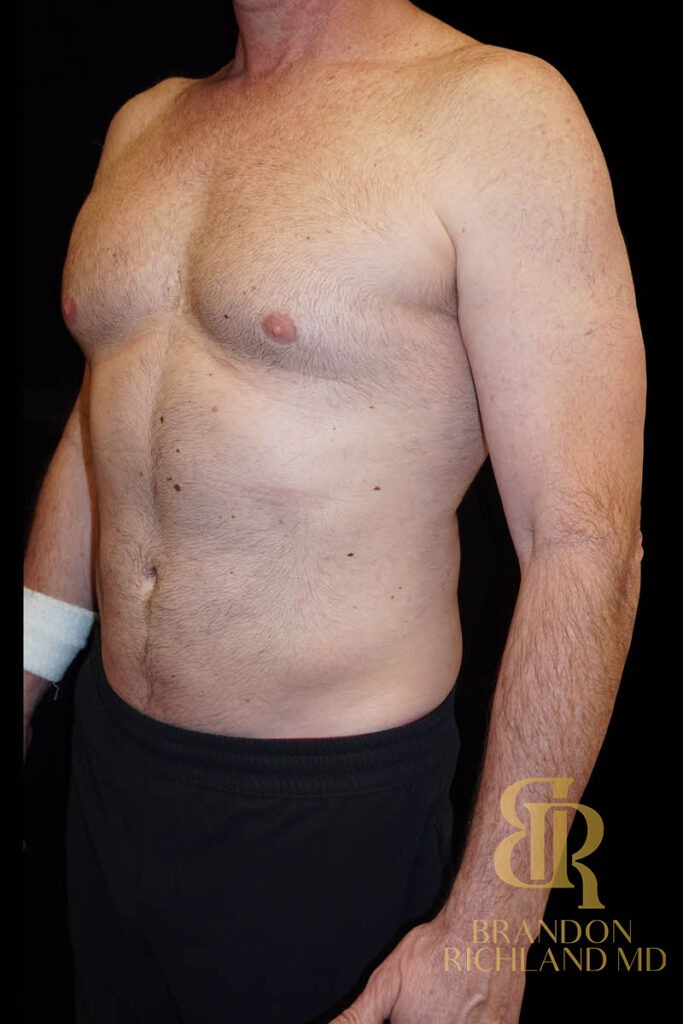 Liposuction After, Patient 03, view 6 — Dr. Brandon Richland, Newport Beach