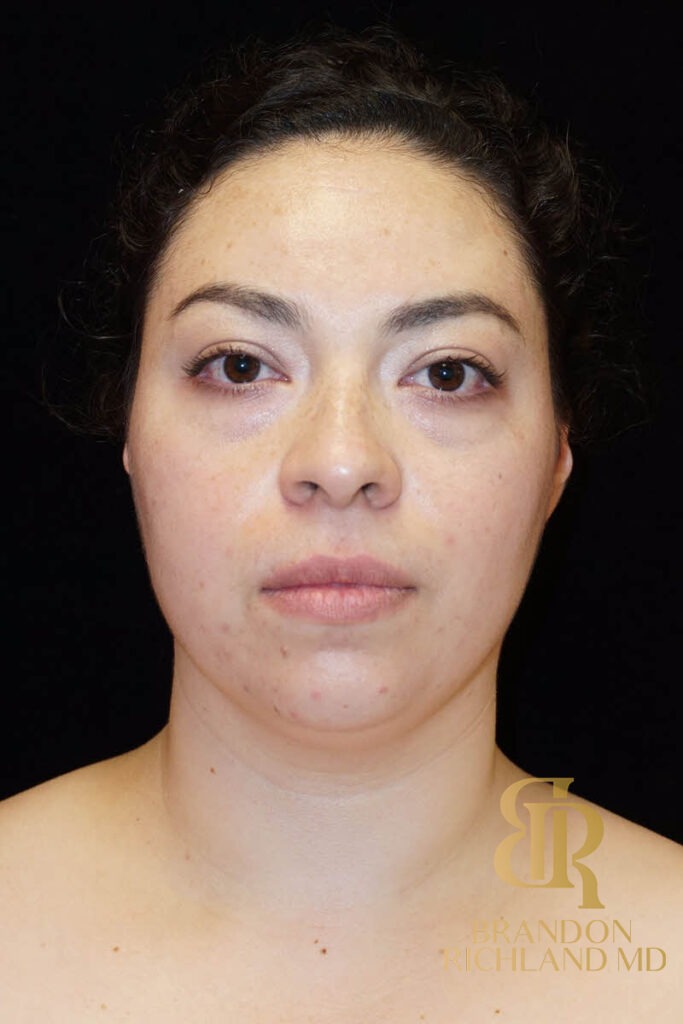 Liposuction Before, Patient 04, view 1 — Dr. Brandon Richland, Newport Beach