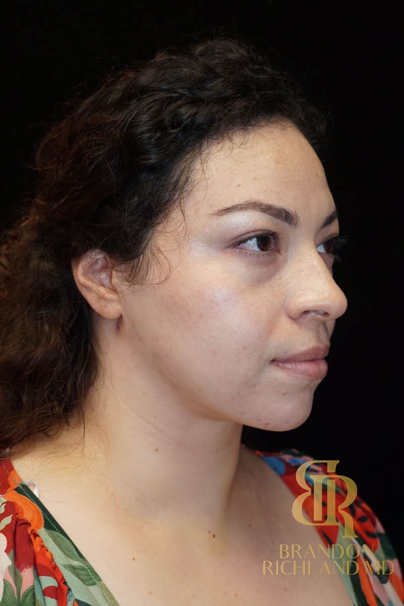 Liposuction before and after, Patient 04 — Dr. Brandon Richland, Newport Beach