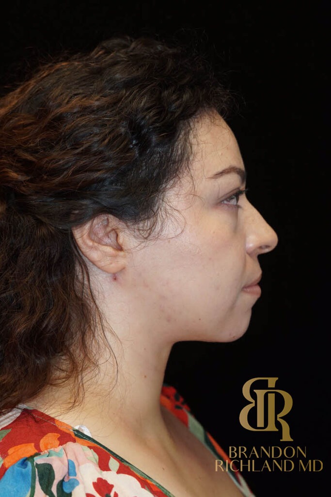 Liposuction After, Patient 04, view 3 — Dr. Brandon Richland, Newport Beach