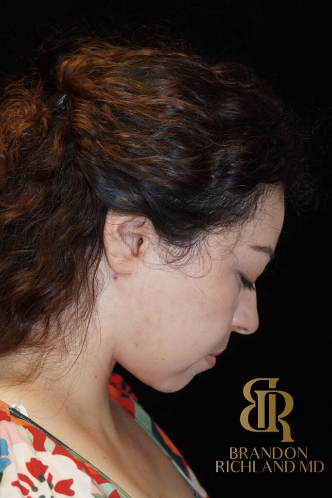 Liposuction After, Patient 04, view 4 — Dr. Brandon Richland, Newport Beach