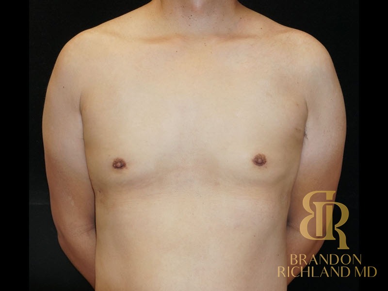 Liposuction After, Patient 06, view 1 — Dr. Brandon Richland, Newport Beach