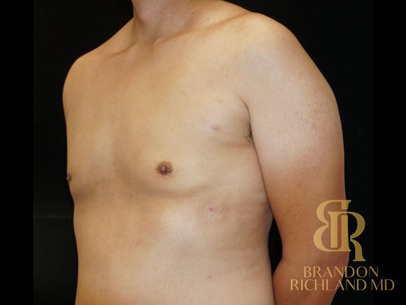 Liposuction After, Patient 06, view 4 — Dr. Brandon Richland, Newport Beach