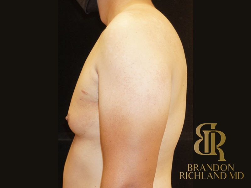 Liposuction Before, Patient 06, view 5 — Dr. Brandon Richland, Newport Beach