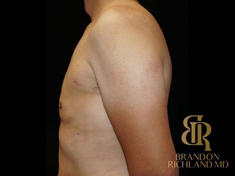 Liposuction After, Patient 06, view 5 — Dr. Brandon Richland, Newport Beach