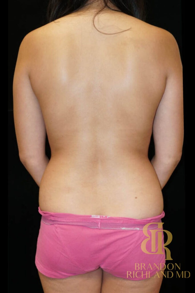 Liposuction Before, Patient 07, view 6 — Dr. Brandon Richland, Newport Beach