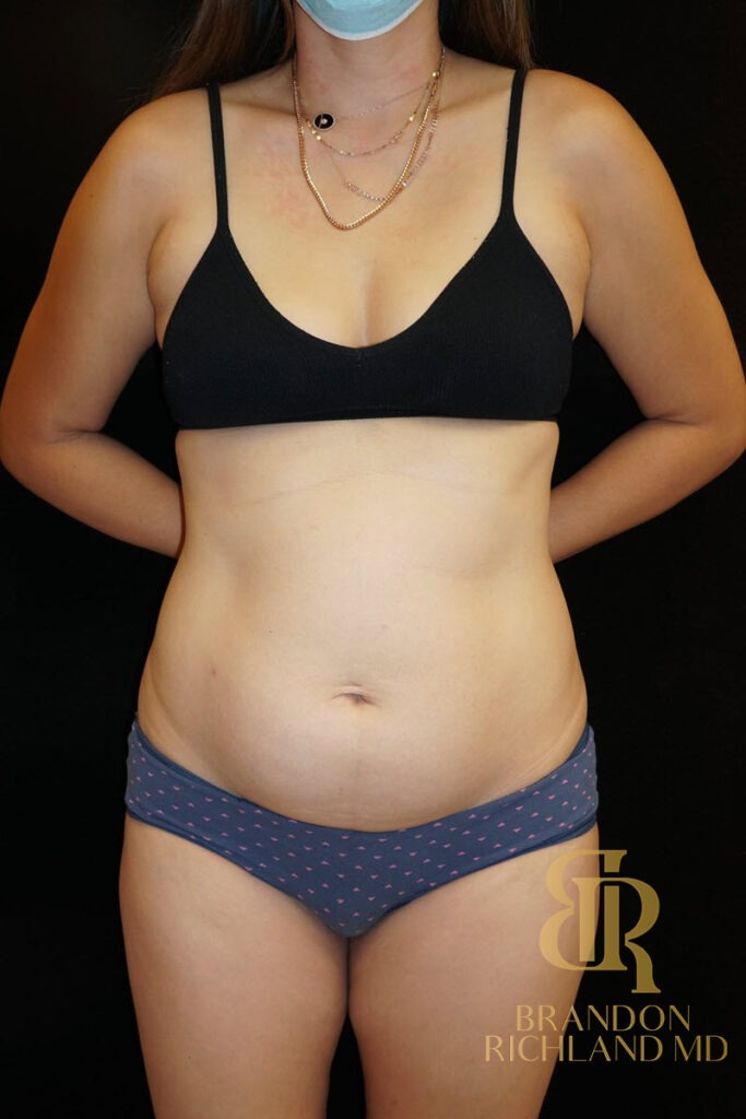 Liposuction Before, Patient 08, view 1 — Dr. Brandon Richland, Newport Beach