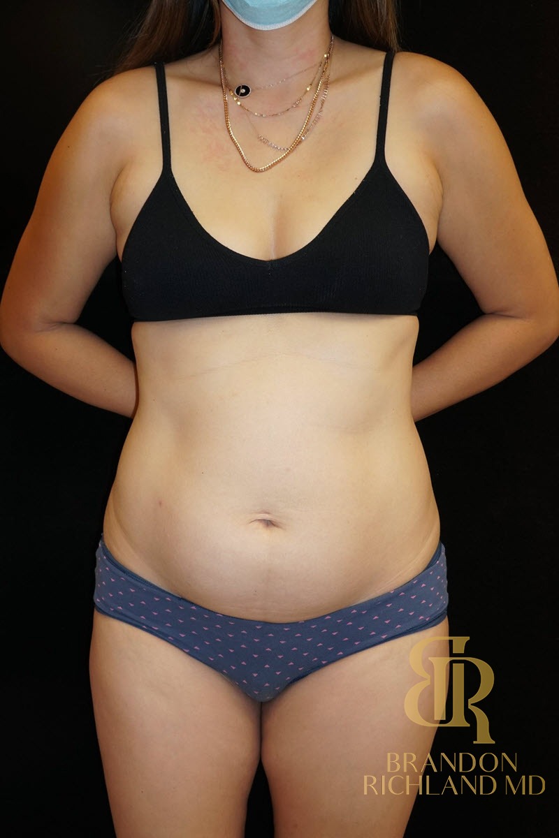 Liposuction before and after, Patient 08 — Dr. Brandon Richland, Newport Beach