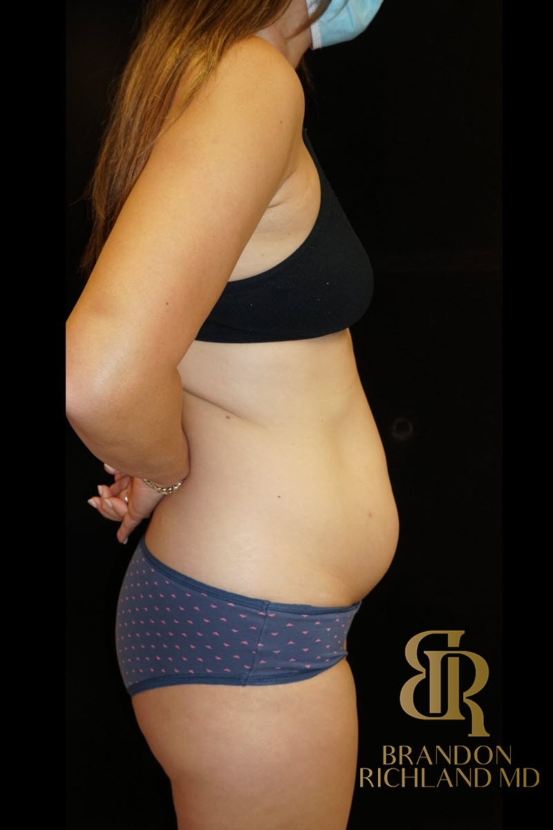 Liposuction before and after, Patient 08 — Dr. Brandon Richland, Newport Beach