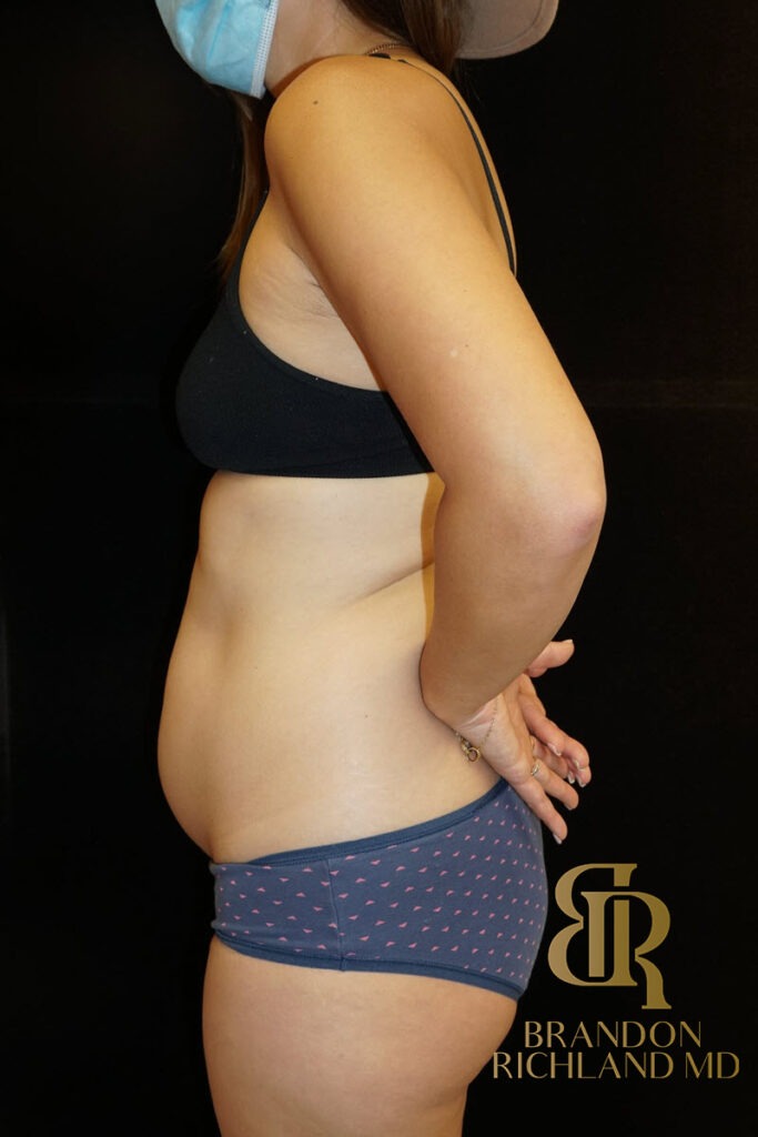 Liposuction Before, Patient 08, view 5 — Dr. Brandon Richland, Newport Beach
