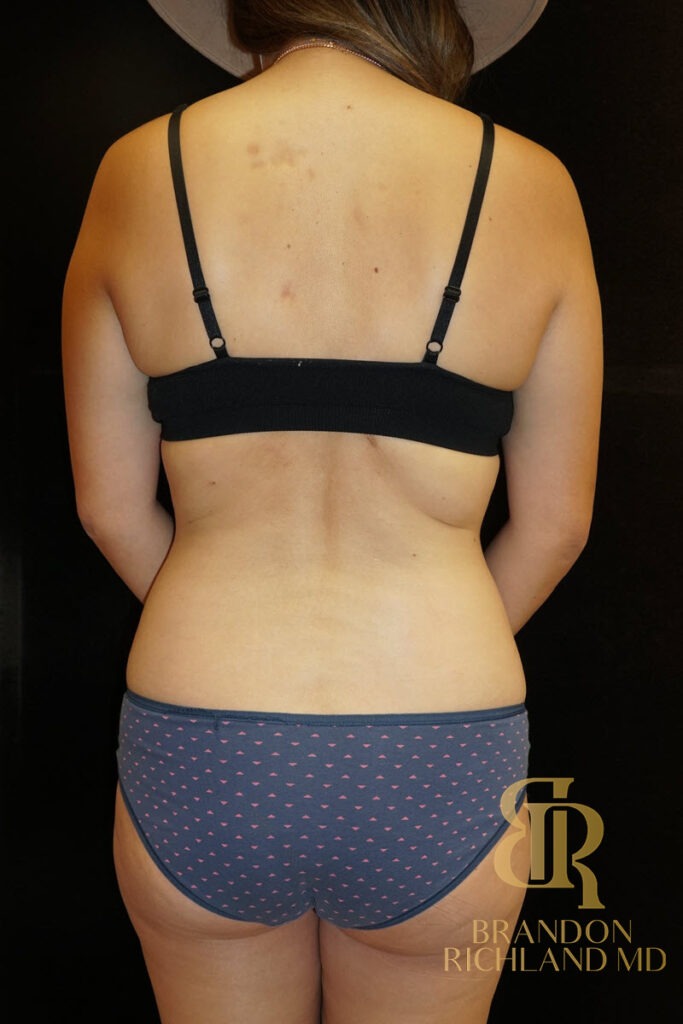 Liposuction Before, Patient 08, view 6 — Dr. Brandon Richland, Newport Beach