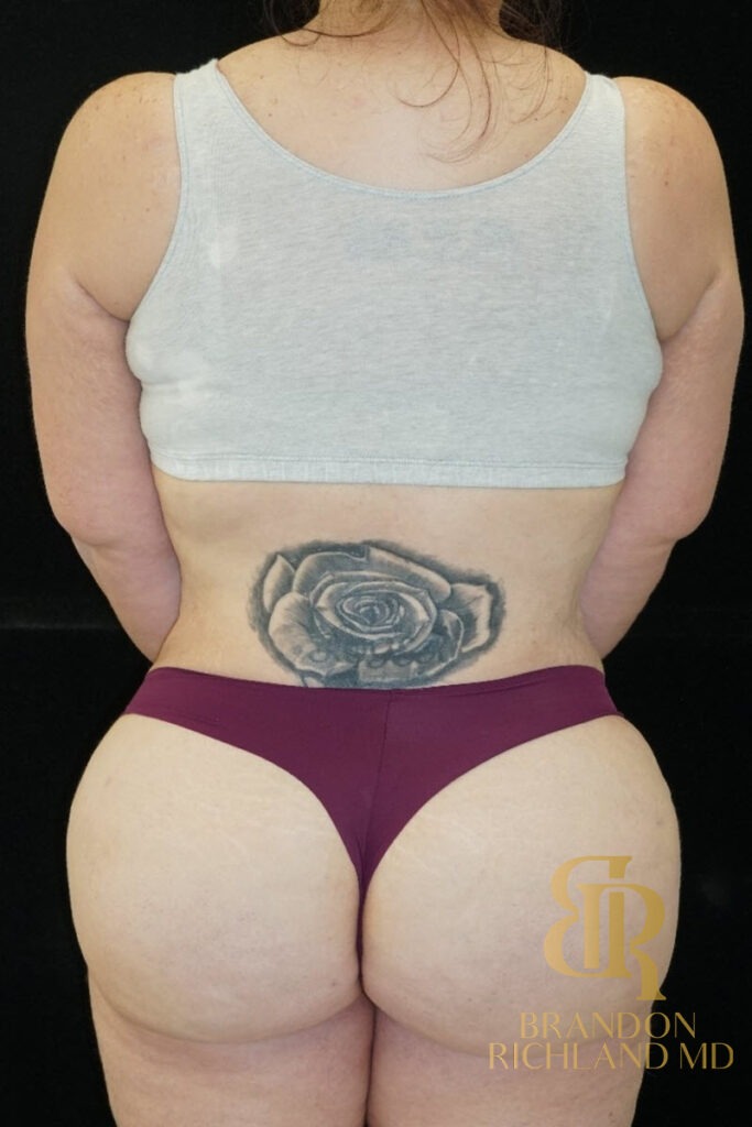 Liposuction After, Patient 09, view 6 — Dr. Brandon Richland, Newport Beach
