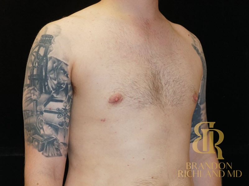 Liposuction before and after, Patient 10 — Dr. Brandon Richland, Newport Beach