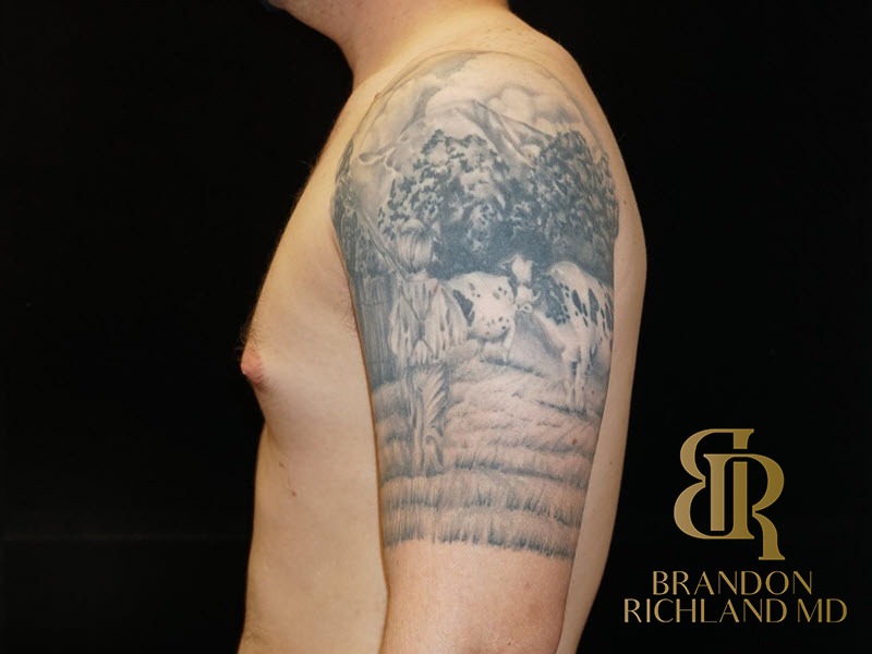Liposuction Before, Patient 10, view 5 — Dr. Brandon Richland, Newport Beach