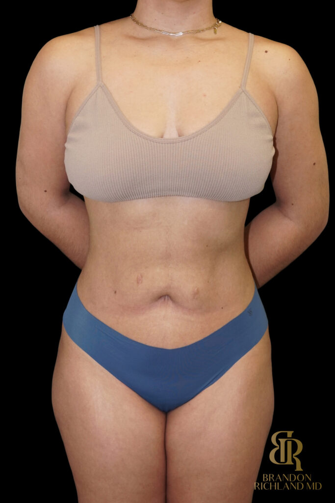 Liposuction After, Case #10569, view 1 — Dr. Brandon Richland, Newport Beach