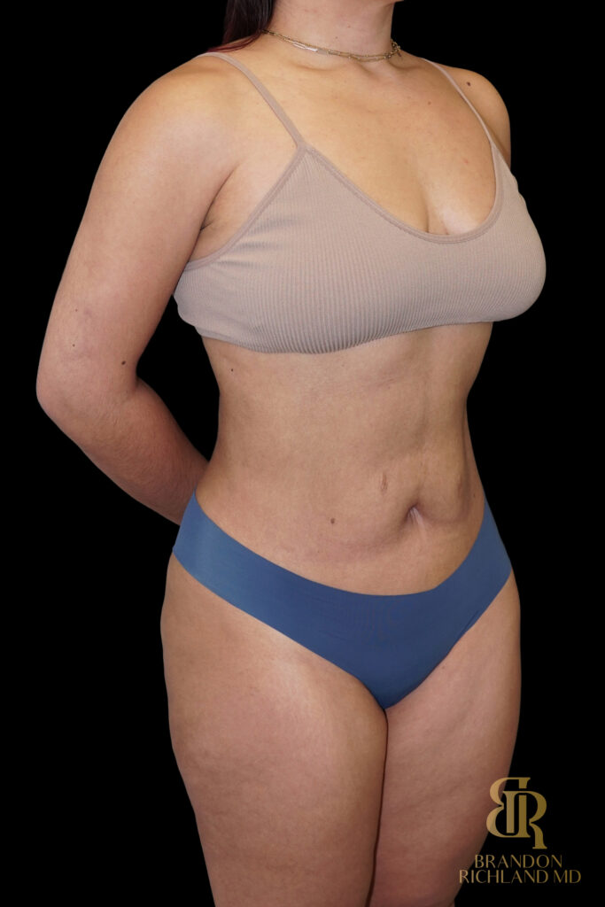 Liposuction After, Case #10569, view 2 — Dr. Brandon Richland, Newport Beach