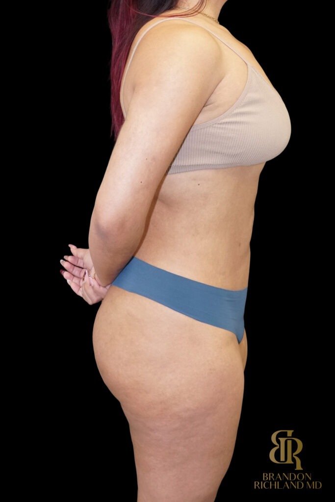 Liposuction After, Case #10569, view 3 — Dr. Brandon Richland, Newport Beach