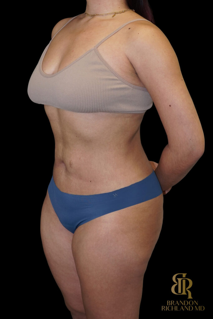 Liposuction After, Case #10569, view 4 — Dr. Brandon Richland, Newport Beach