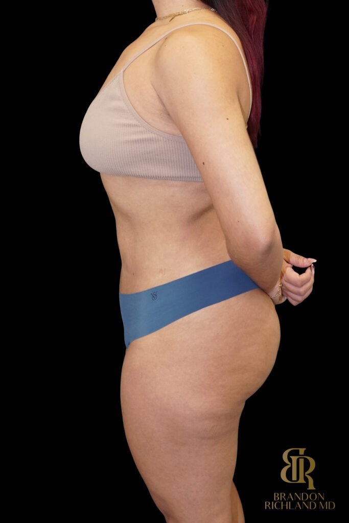 Liposuction After, Case #10569, view 5 — Dr. Brandon Richland, Newport Beach