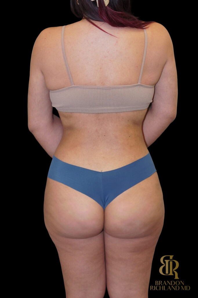 Liposuction After, Case #10569, view 6 — Dr. Brandon Richland, Newport Beach