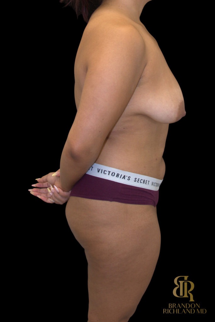 Liposuction Before, Case #10569, view 3 — Dr. Brandon Richland, Newport Beach