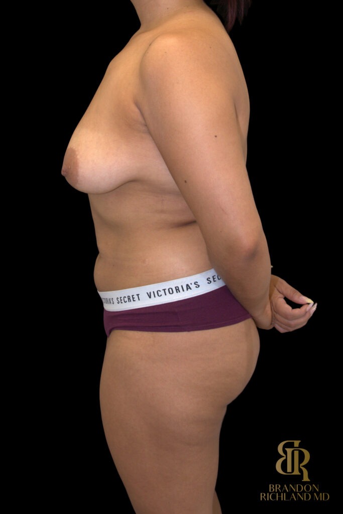 Liposuction Before, Case #10569, view 5 — Dr. Brandon Richland, Newport Beach