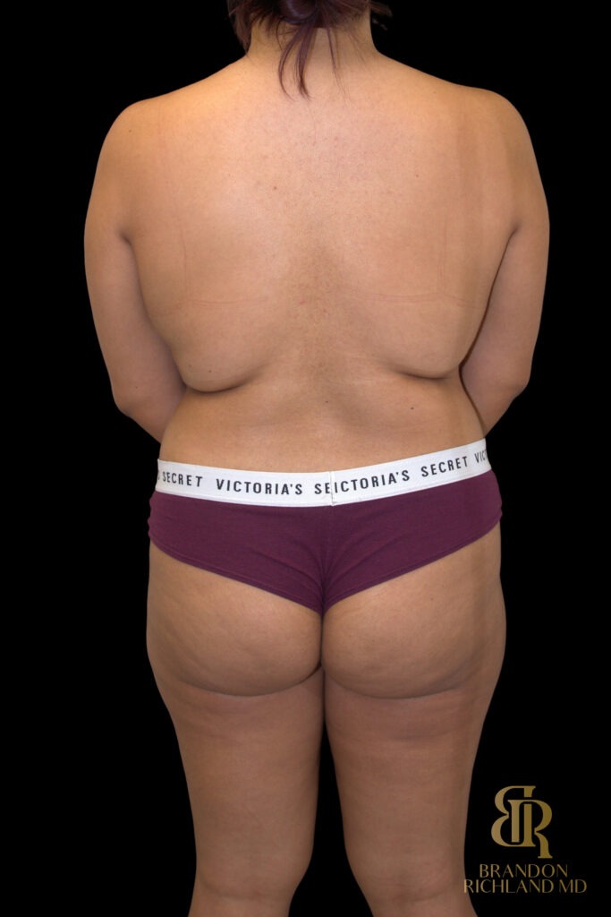 Liposuction Before, Case #10569, view 6 — Dr. Brandon Richland, Newport Beach