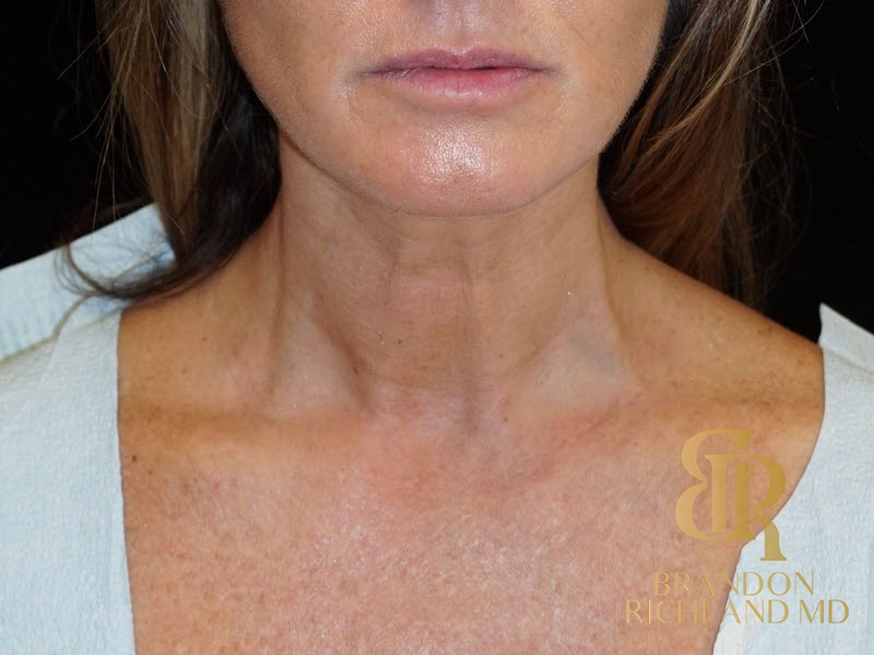 Liposuction before and after, Patient 11 — Dr. Brandon Richland, Newport Beach