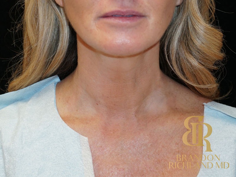 Liposuction before and after, Patient 11 — Dr. Brandon Richland, Newport Beach