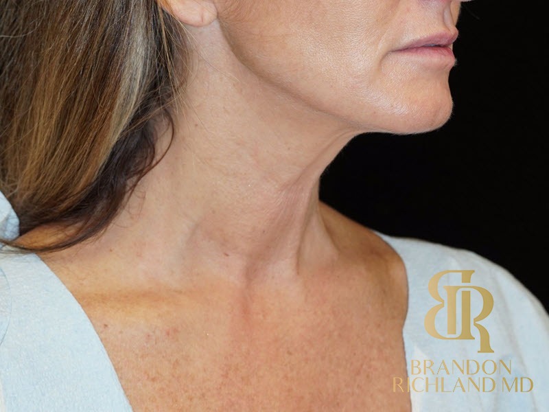 Liposuction before and after, Patient 11 — Dr. Brandon Richland, Newport Beach