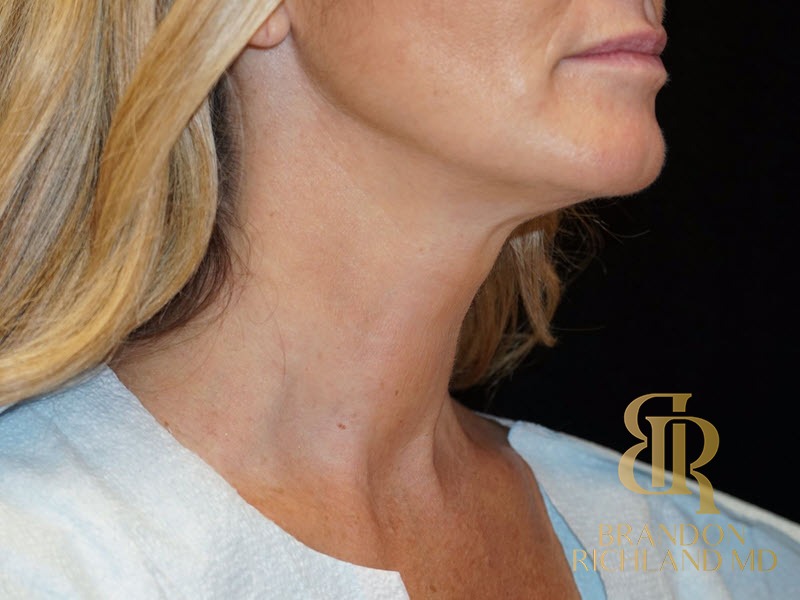 Liposuction before and after, Patient 11 — Dr. Brandon Richland, Newport Beach