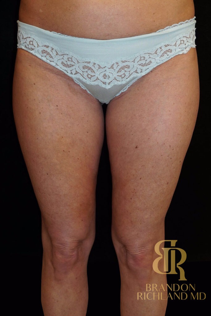 Liposuction Before, Patient 11, view 4 — Dr. Brandon Richland, Newport Beach
