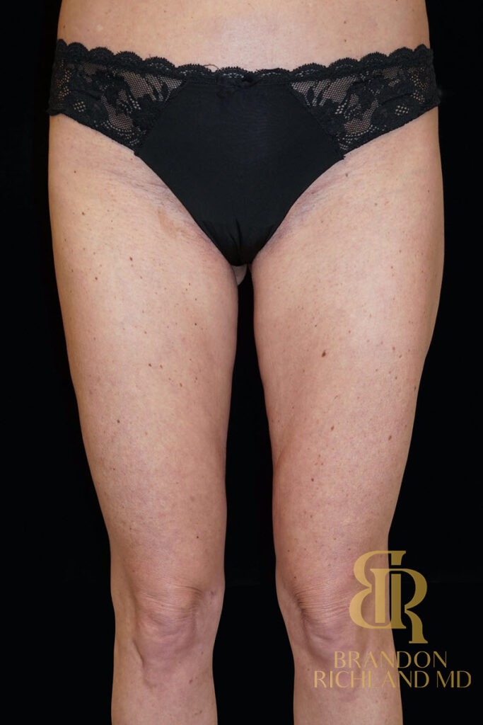 Liposuction After, Patient 11, view 4 — Dr. Brandon Richland, Newport Beach
