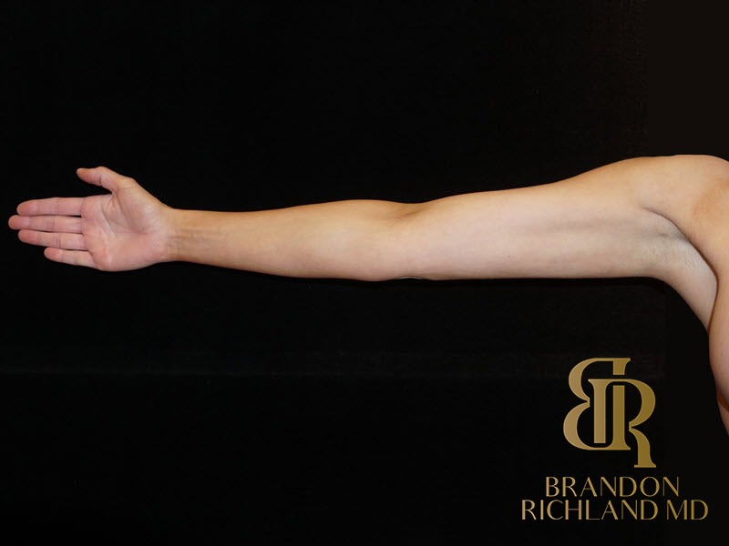 Liposuction After, Patient 12, view 1 — Dr. Brandon Richland, Newport Beach