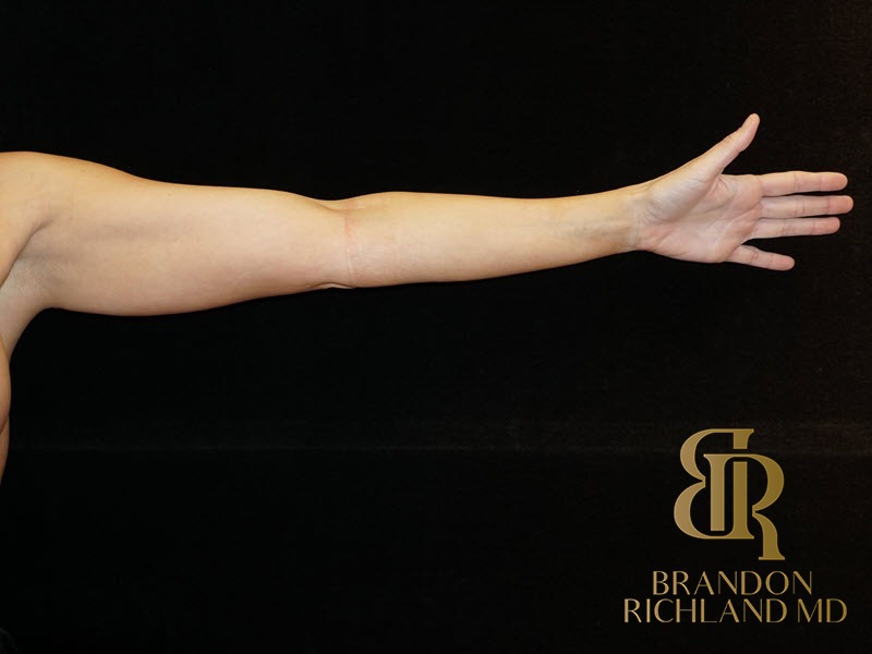 Liposuction Before, Patient 12, view 2 — Dr. Brandon Richland, Newport Beach