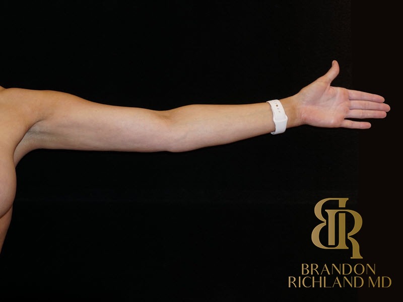 Liposuction After, Patient 12, view 2 — Dr. Brandon Richland, Newport Beach