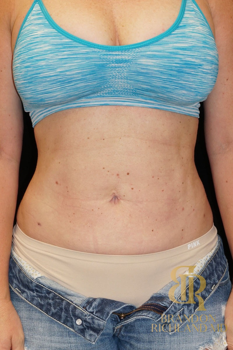 Liposuction before and after, Patient 13 — Dr. Brandon Richland, Newport Beach