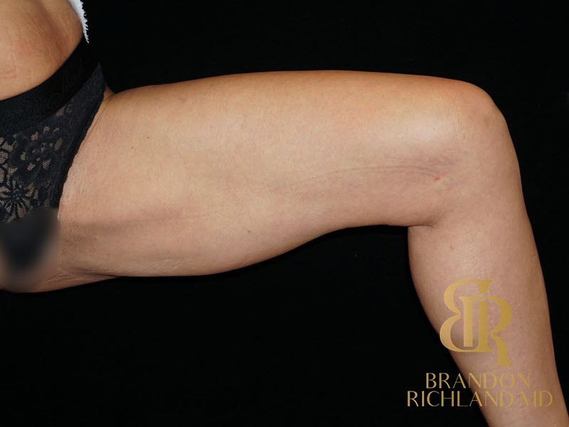 Liposuction Before, Patient 15, view 2 — Dr. Brandon Richland, Newport Beach