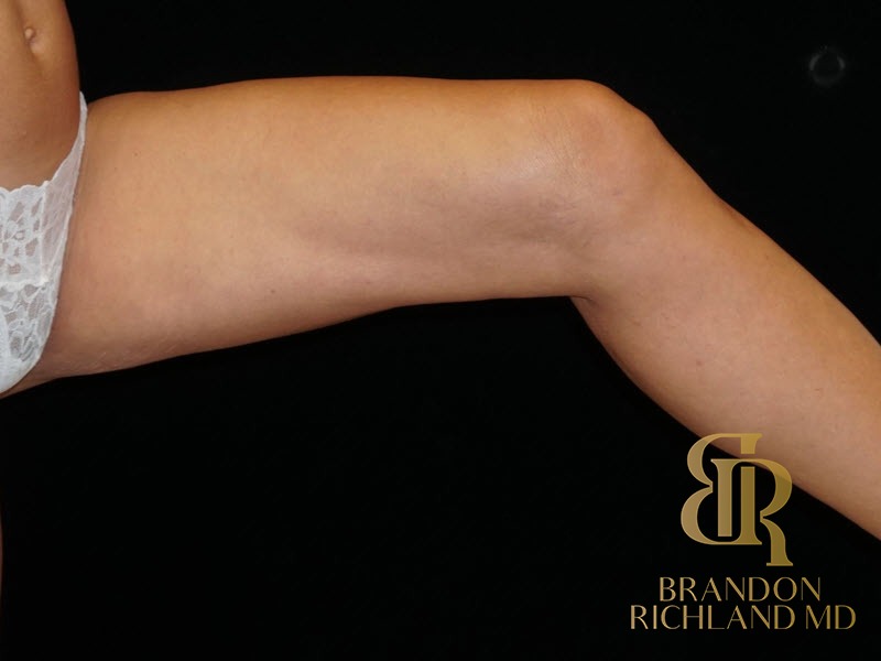 Liposuction After, Patient 15, view 2 — Dr. Brandon Richland, Newport Beach