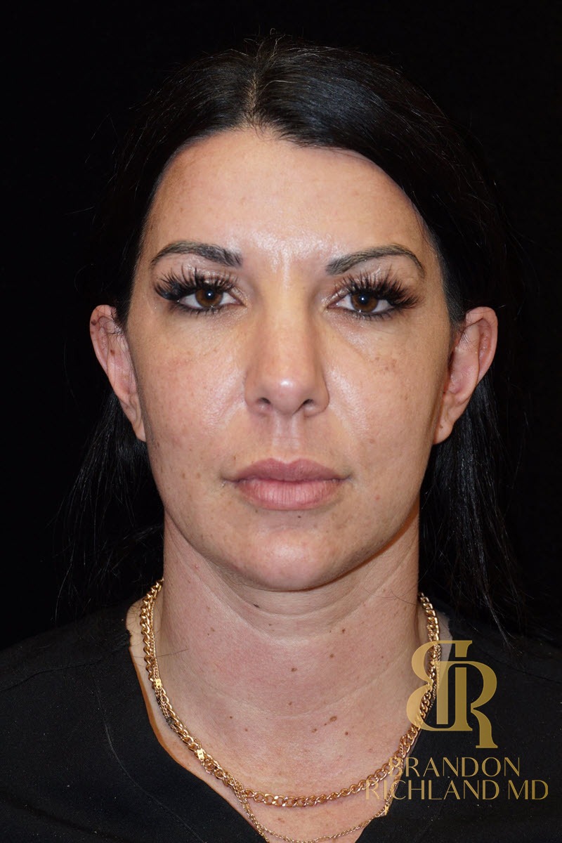 Liposuction before and after, Patient 16 — Dr. Brandon Richland, Newport Beach