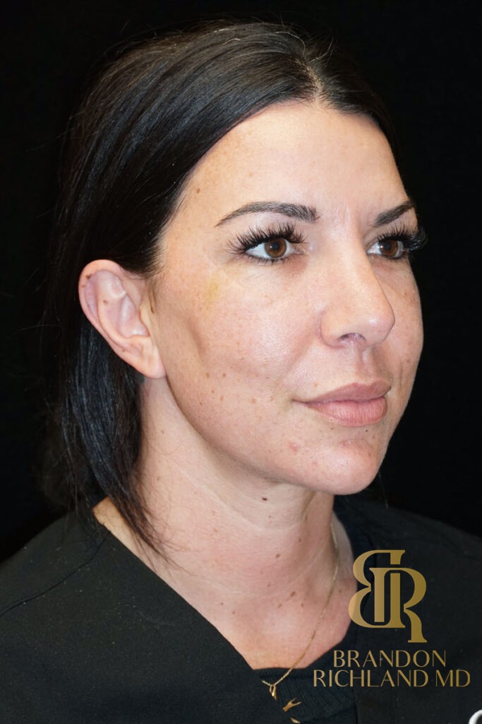 Liposuction After, Patient 16, view 2 — Dr. Brandon Richland, Newport Beach