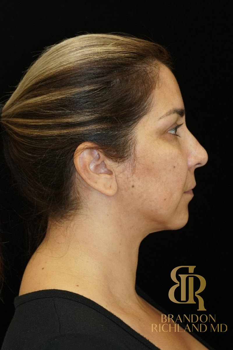 Liposuction before and after, Patient 17 — Dr. Brandon Richland, Newport Beach