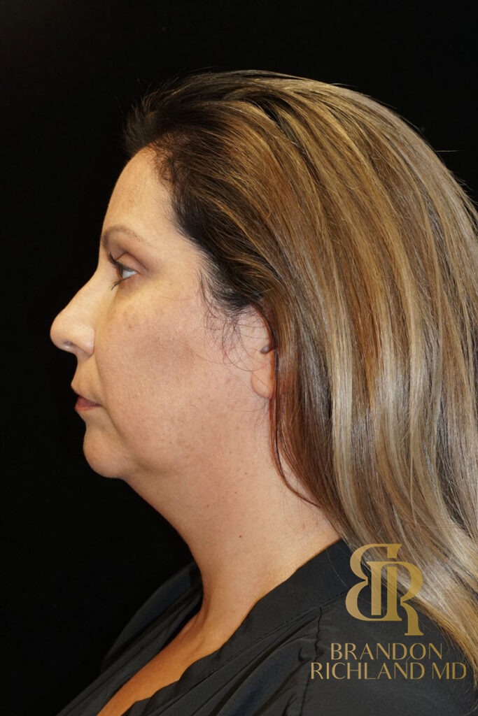 Liposuction Before, Patient 17, view 5 — Dr. Brandon Richland, Newport Beach