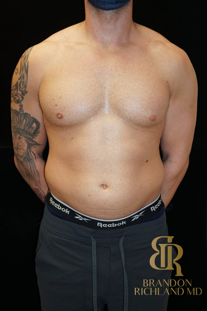 Liposuction Before, Patient 18, view 1 — Dr. Brandon Richland, Newport Beach