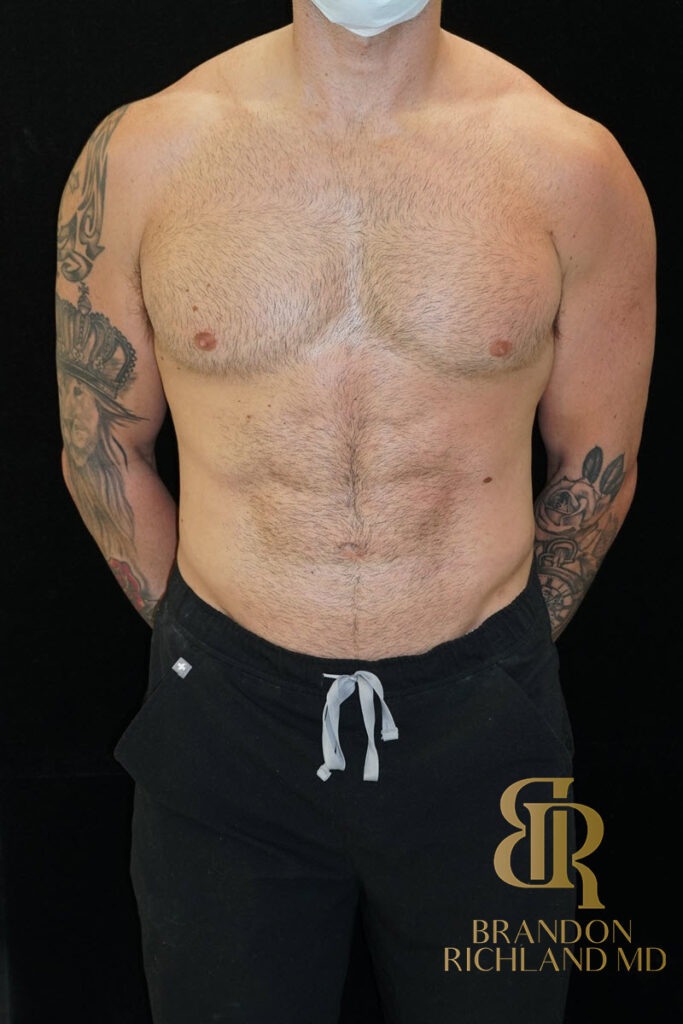 Liposuction After, Patient 18, view 1 — Dr. Brandon Richland, Newport Beach