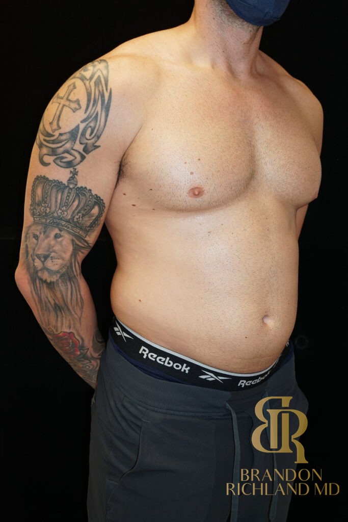 Liposuction Before, Patient 18, view 2 — Dr. Brandon Richland, Newport Beach