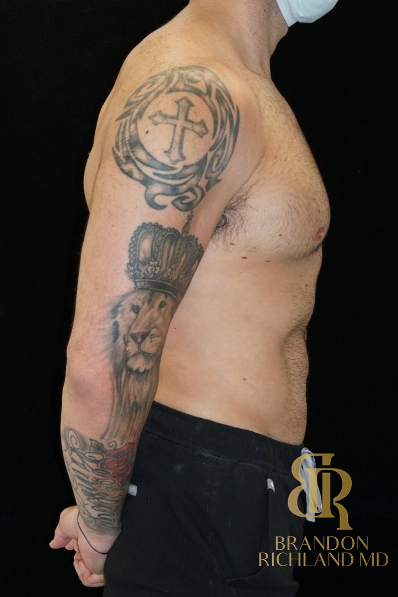 Liposuction before and after, Patient 18 — Dr. Brandon Richland, Newport Beach
